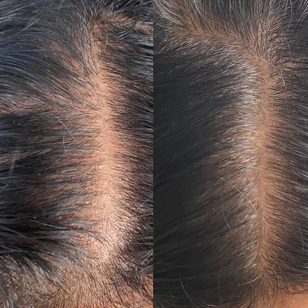 Advanced Scalp Care Starter Set