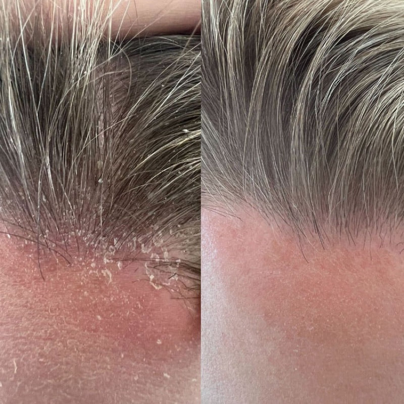 Before and after at the hairline